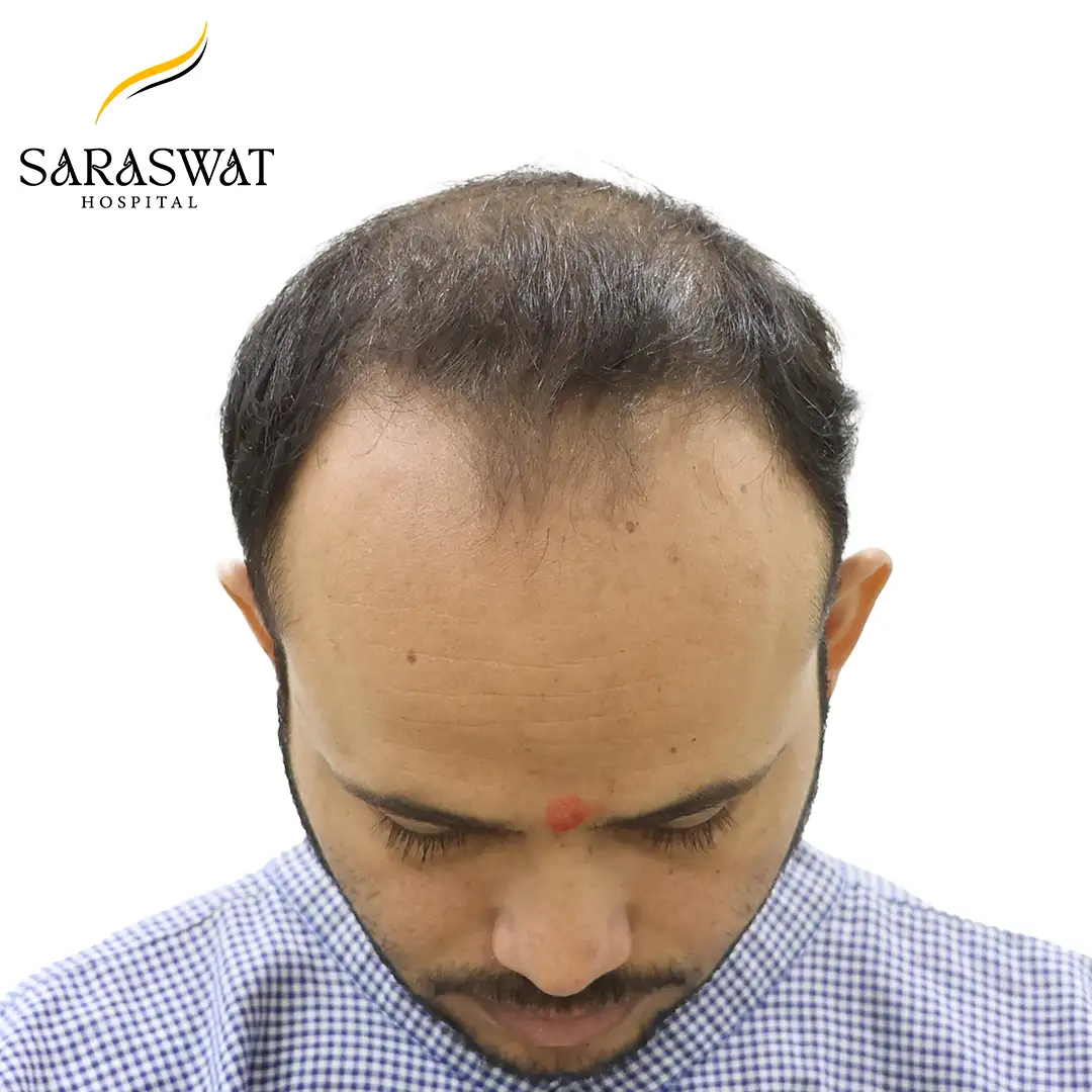 Top FUE Hair Transplant Result Before Procedure