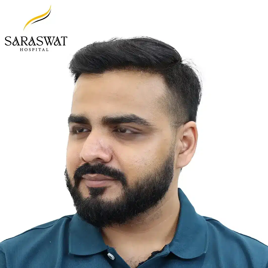 45 Degree Left FUE Hair Transplant Result After Procedure