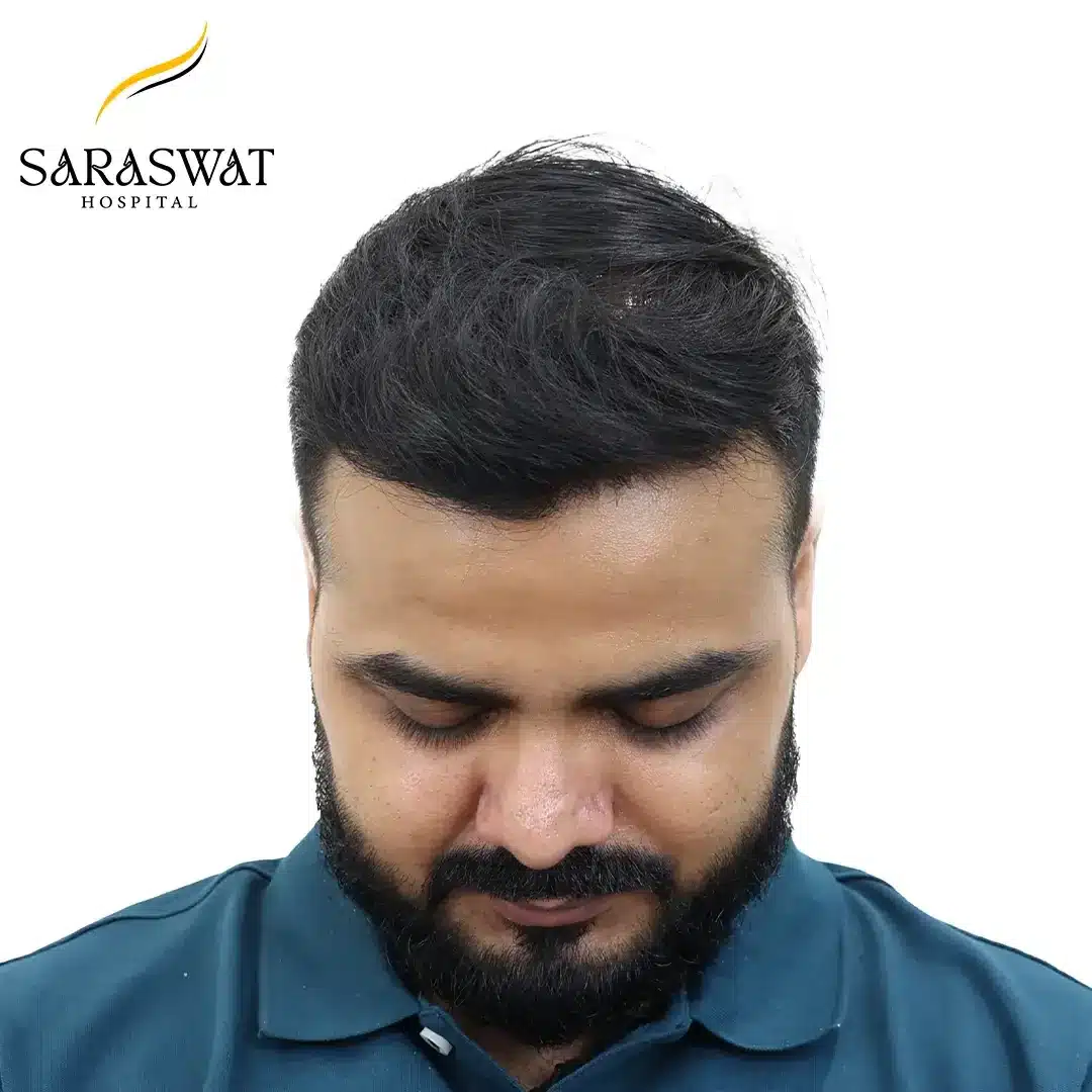 Hair Transplant Result