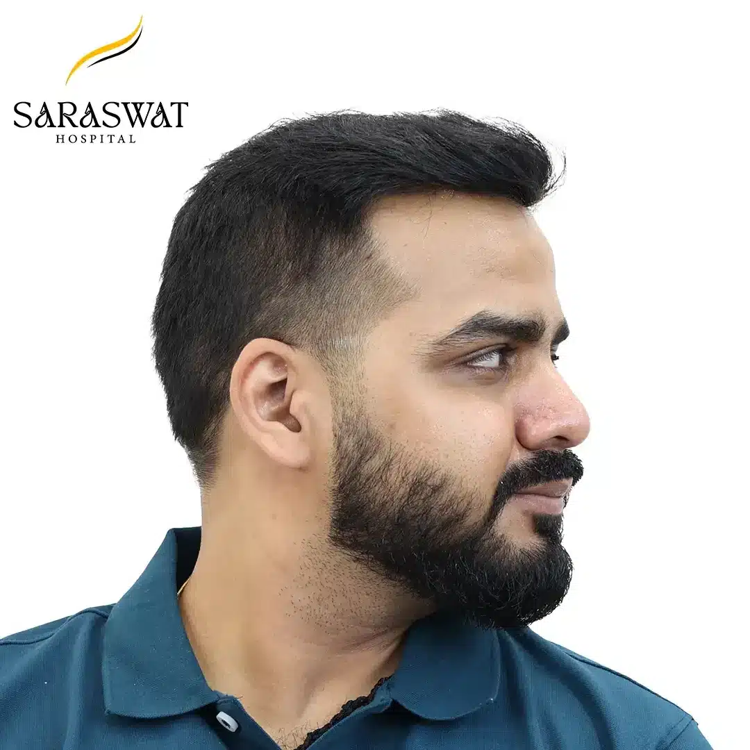 90 Degree Right FUE Hair Transplant Result After Procedure