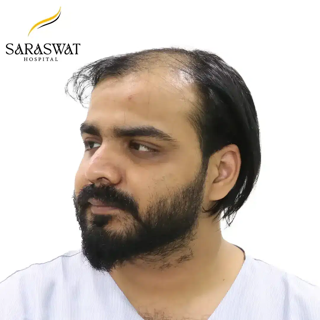 45 Degree Left FUE Hair Transplant Result Before Procedure