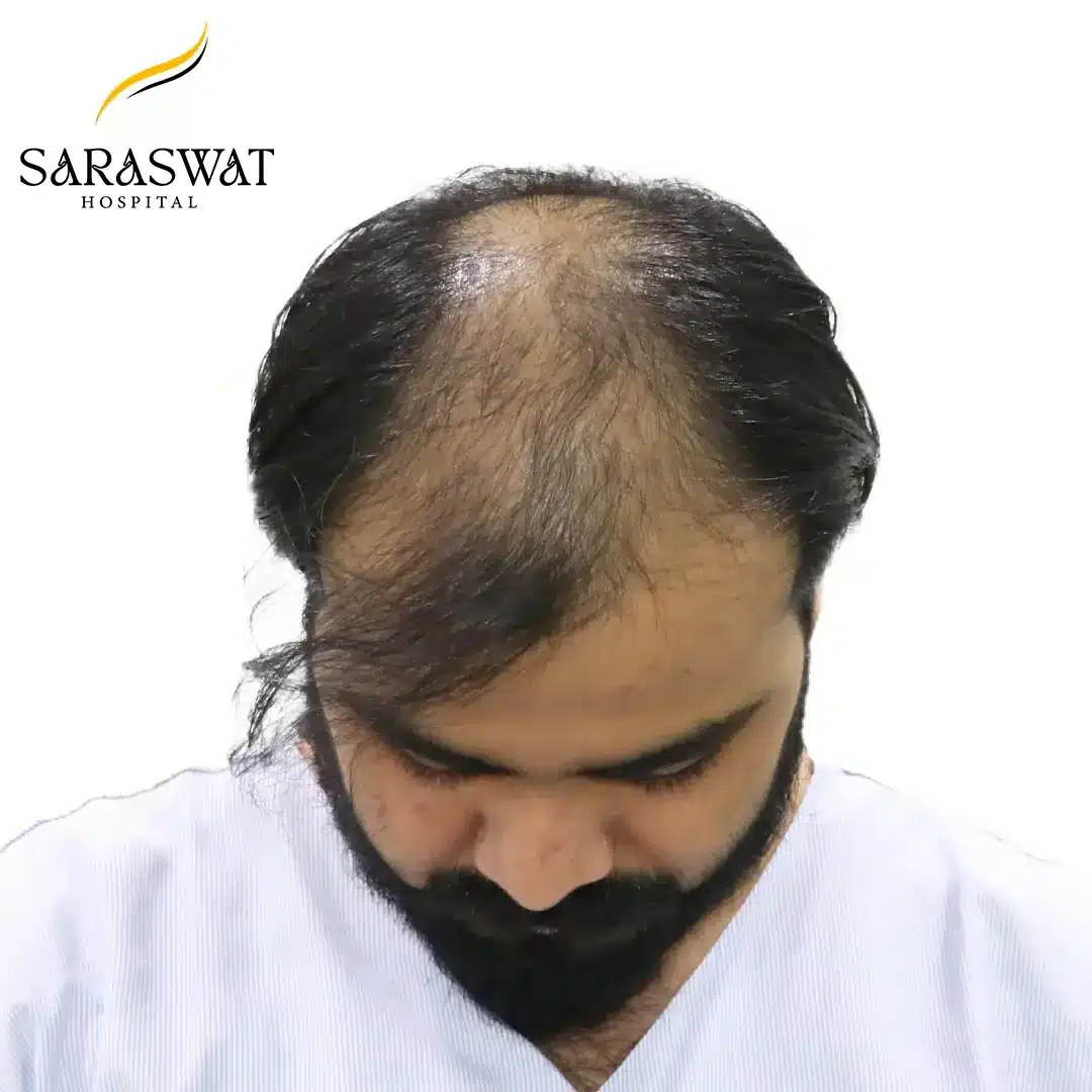 Top FUE Hair Transplant Result Before Procedure