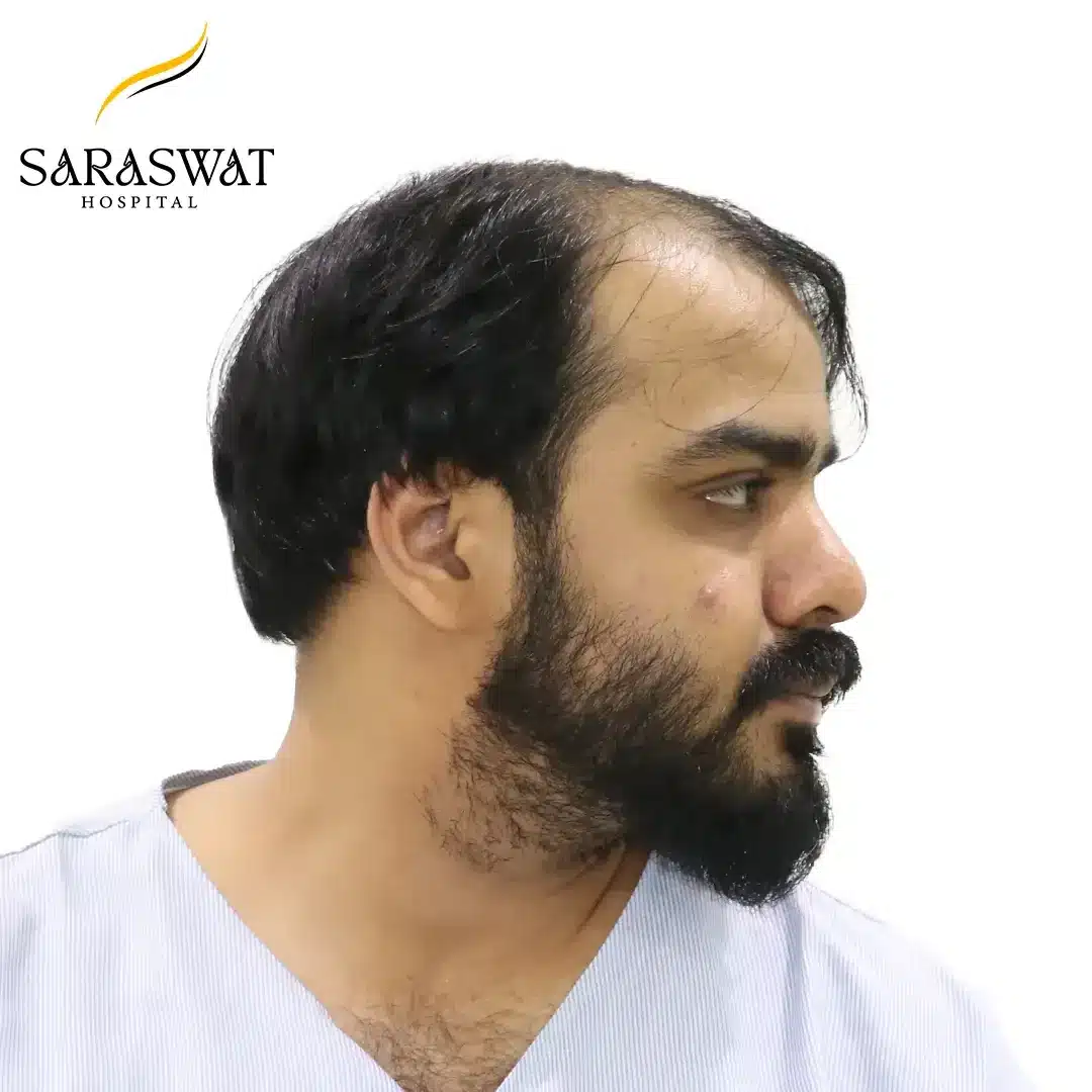 90 Degree Right FUE Hair Transplant Result Before Procedure