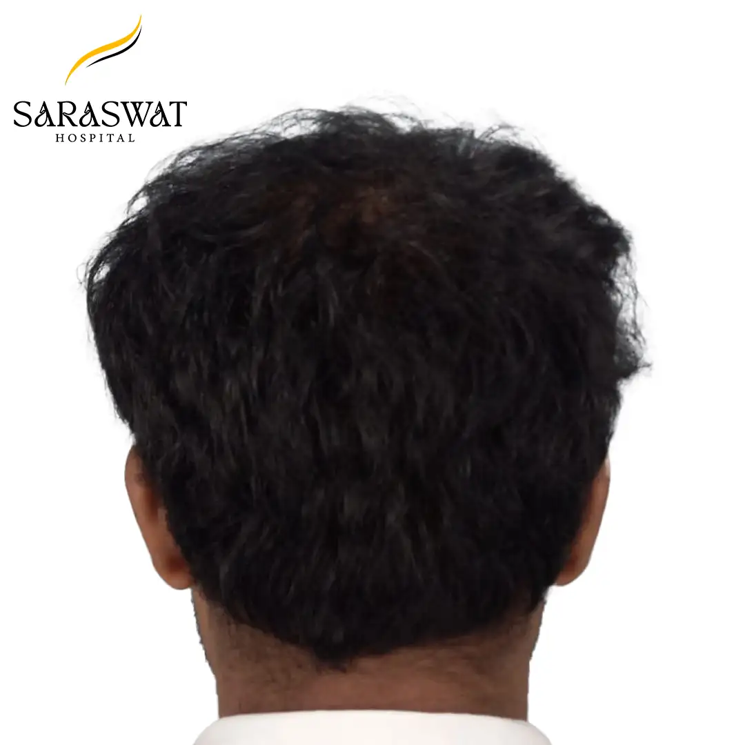 Hair Transplant Before After