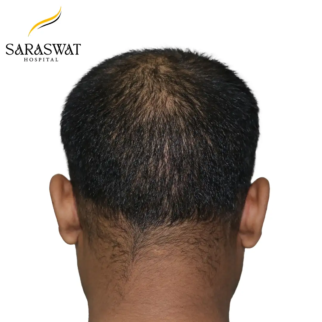 Hair Transplant Before After