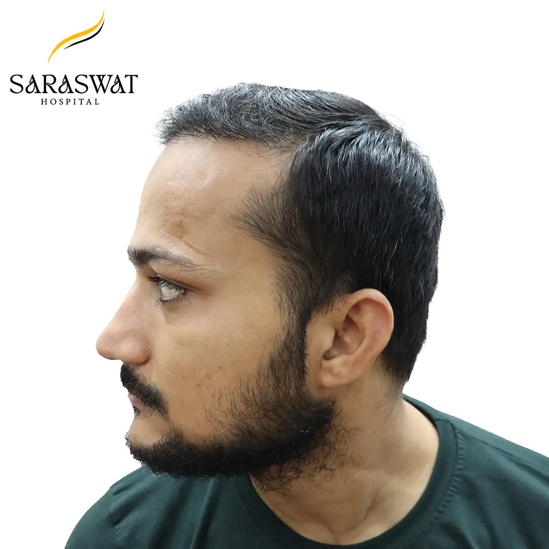 Hair Transplant Before and After