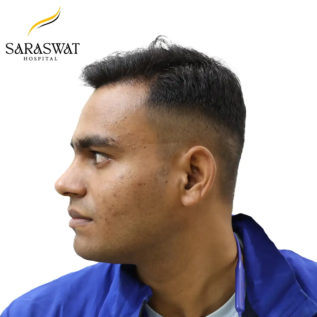 90 Degree Left FUE Hair Transplant Result After Procedure