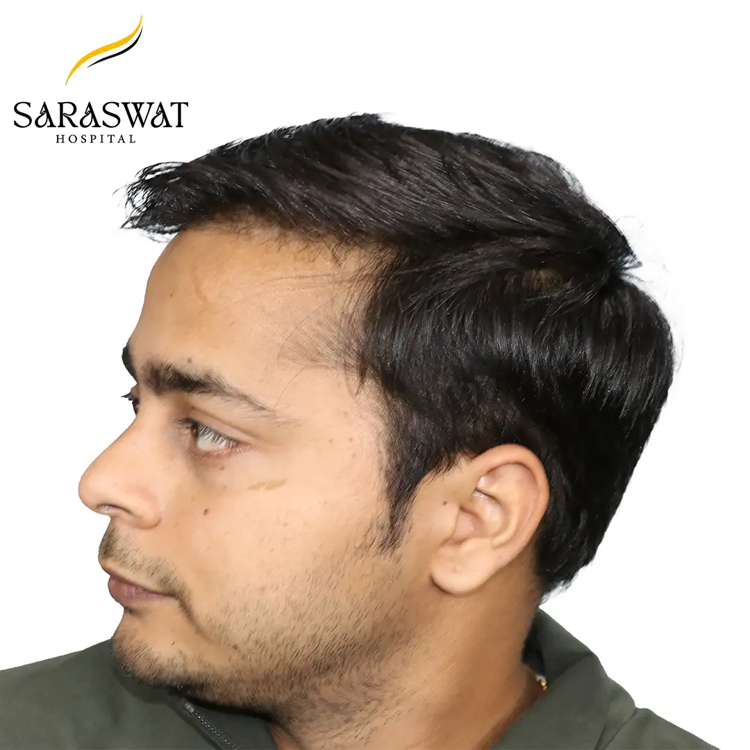 Hair Transplant Before After