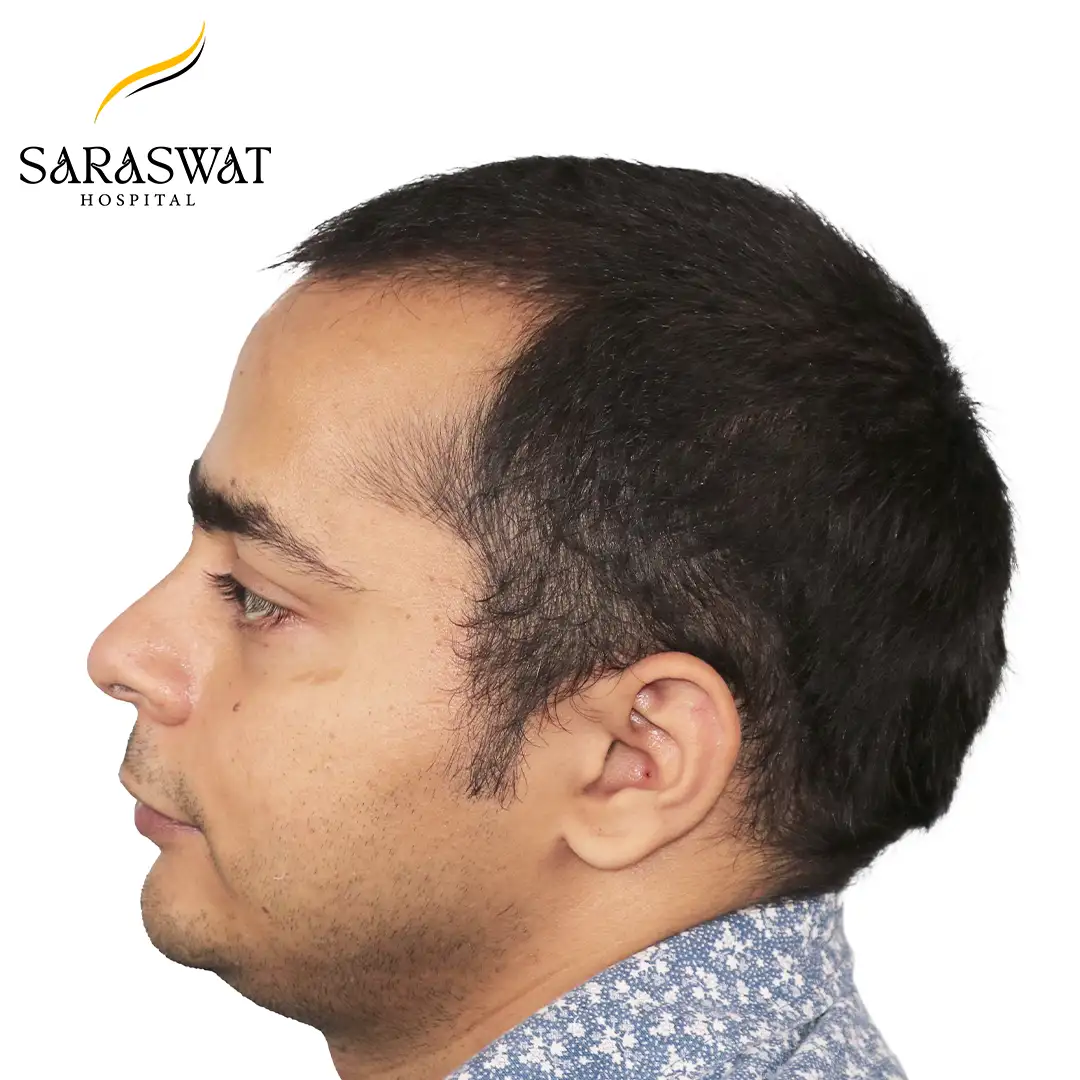 Hair Transplant Before After