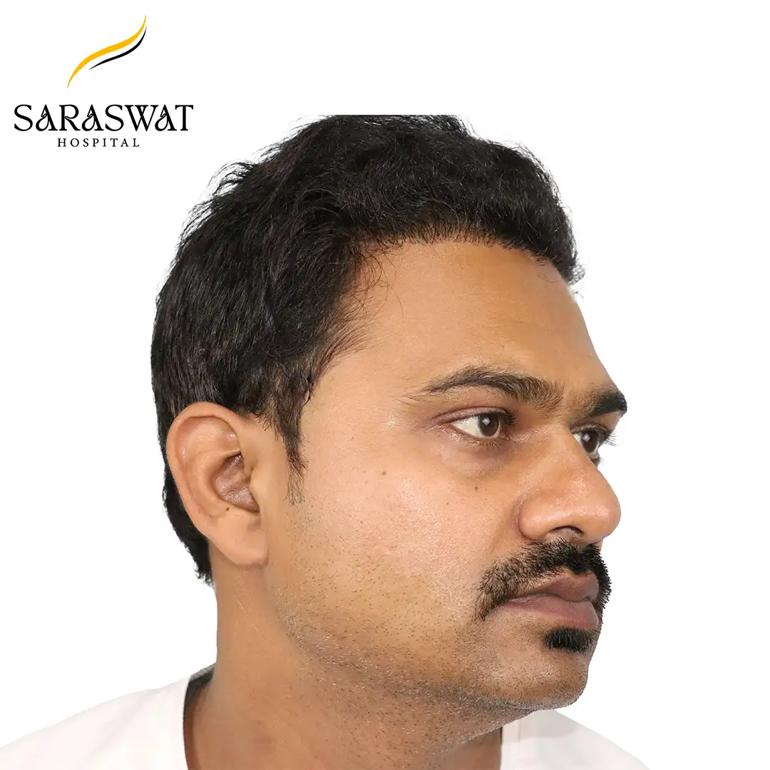 Hair Transplant Before After