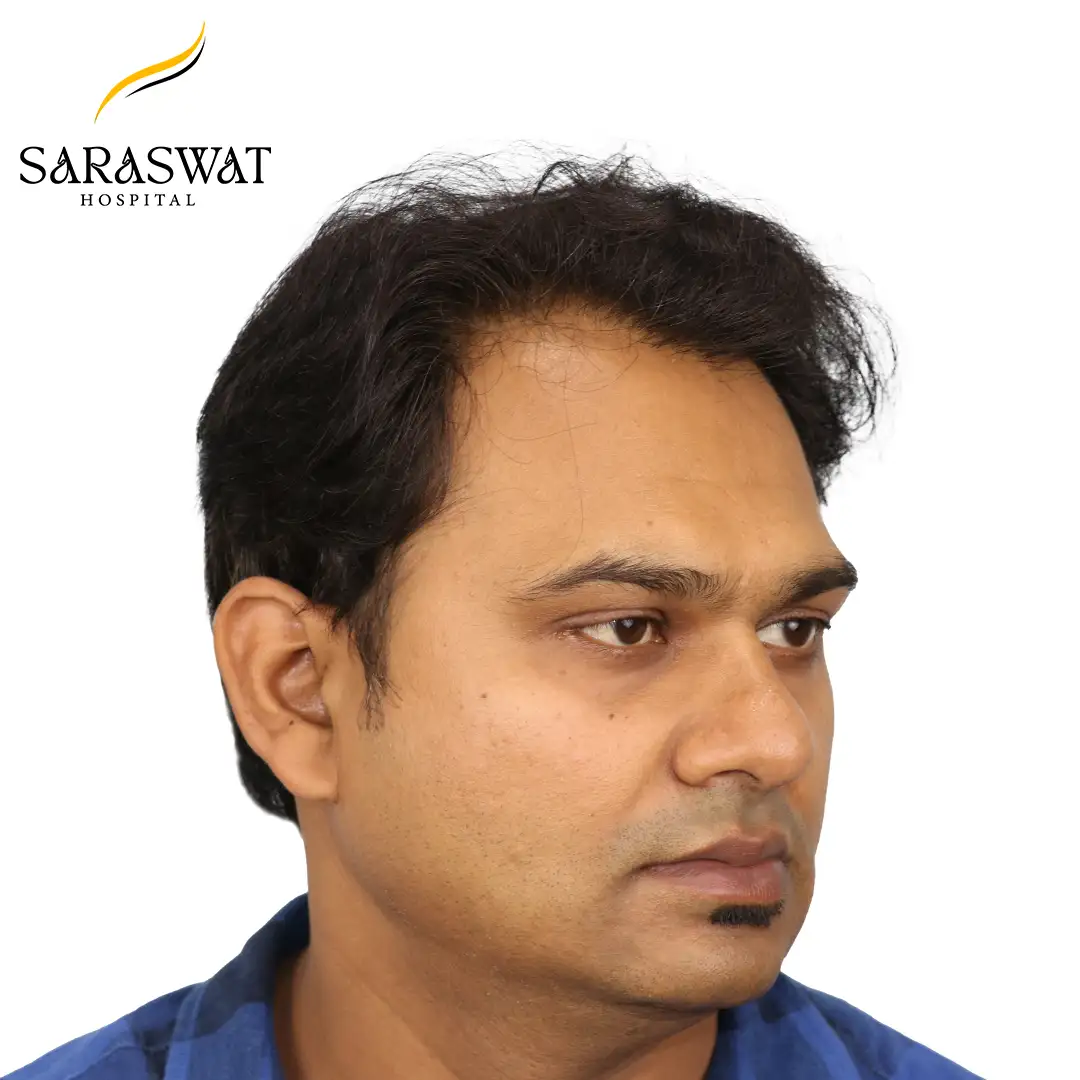 Hair Transplant Before After