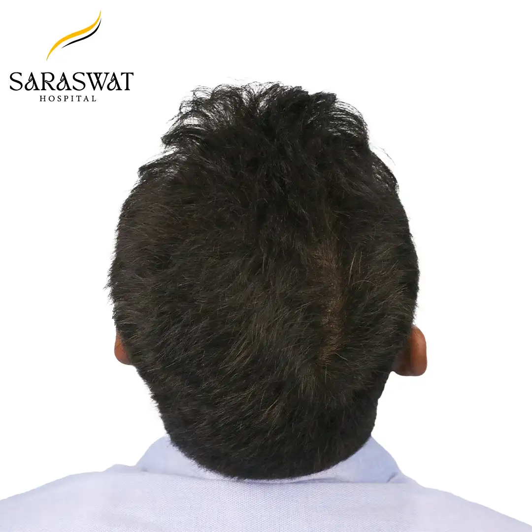 Hair Transplant Before and After Results