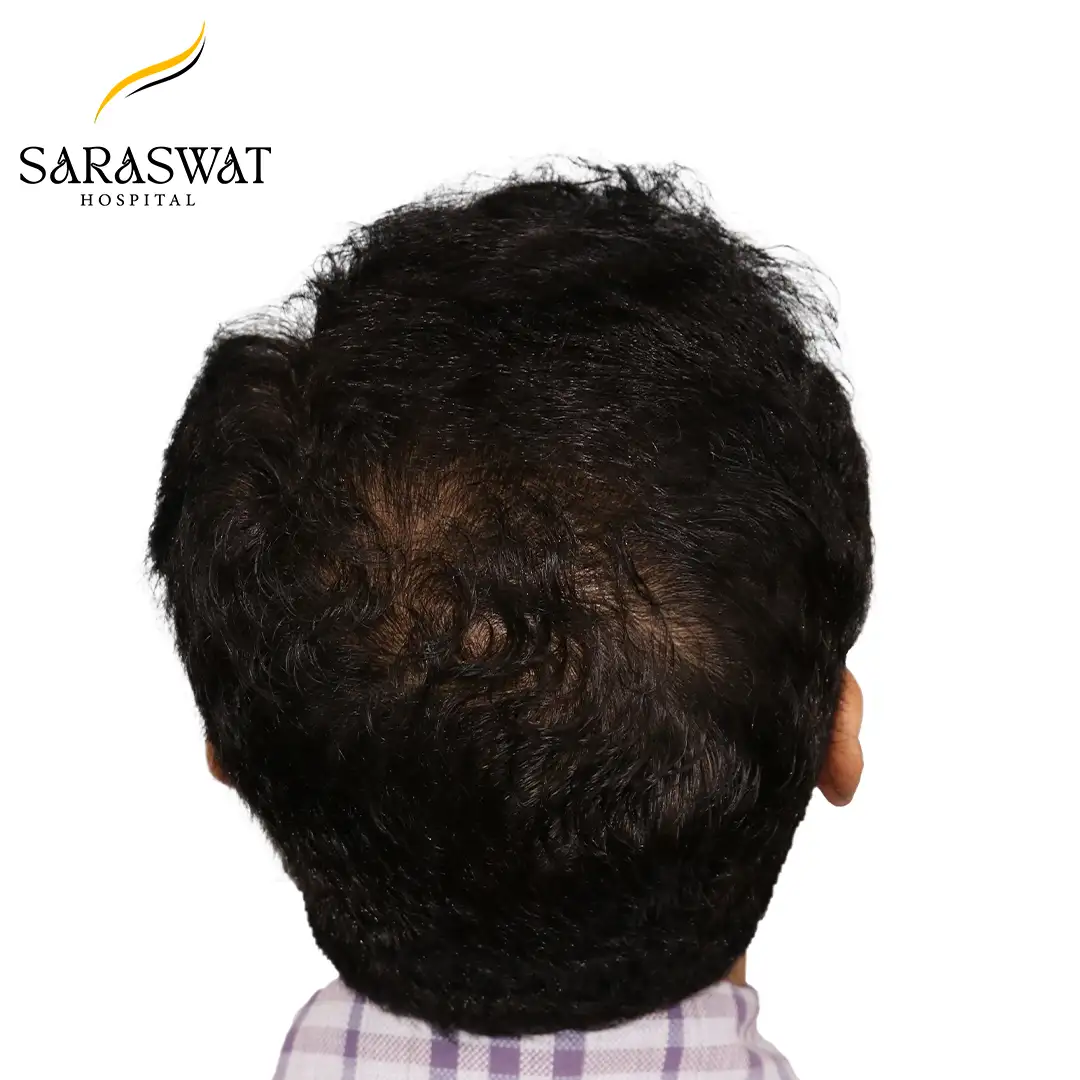 Hair Transplant Before After