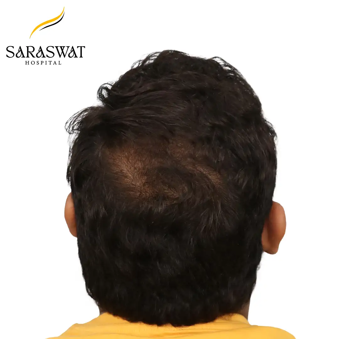FUE Hair Transplant
