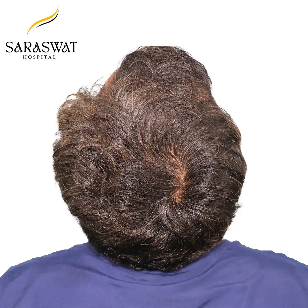 Hair Transplant Before and After Results