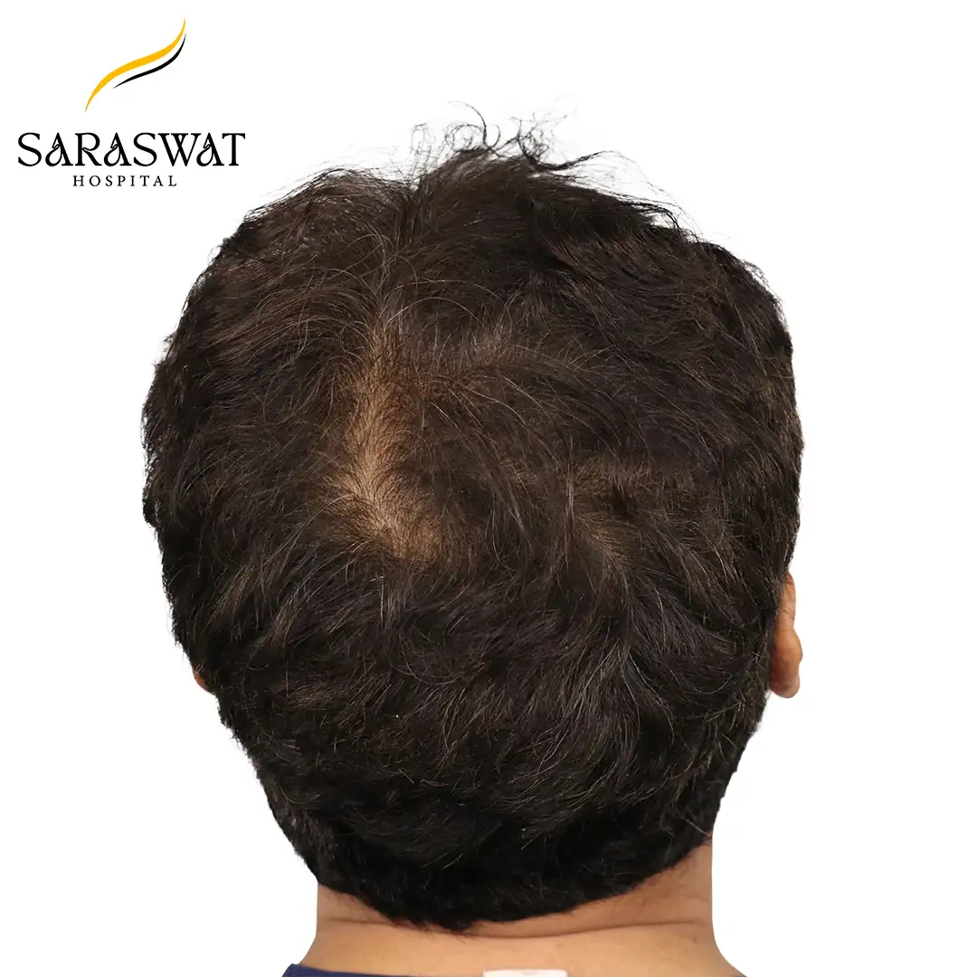 Hair Transplant Before After