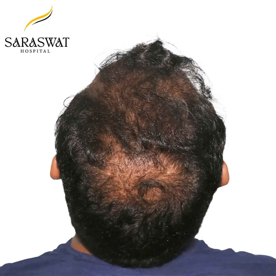 Hair Transplant Before After