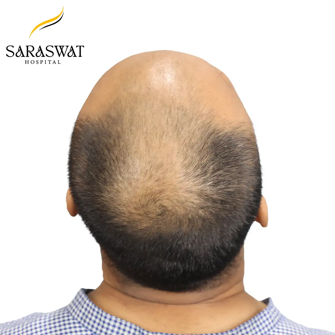 Hair Transplant Before and After