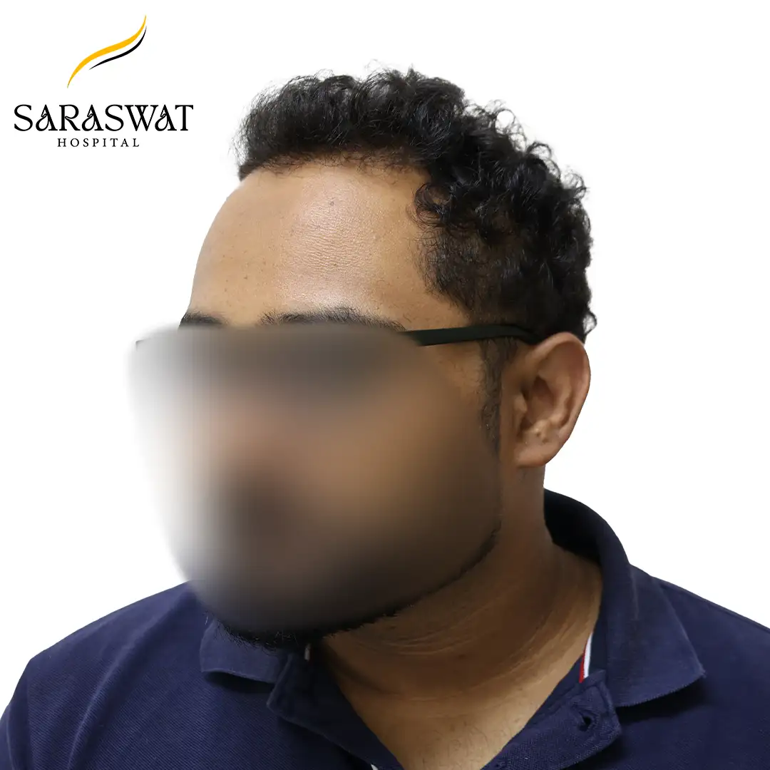 Hair Transplant Before After