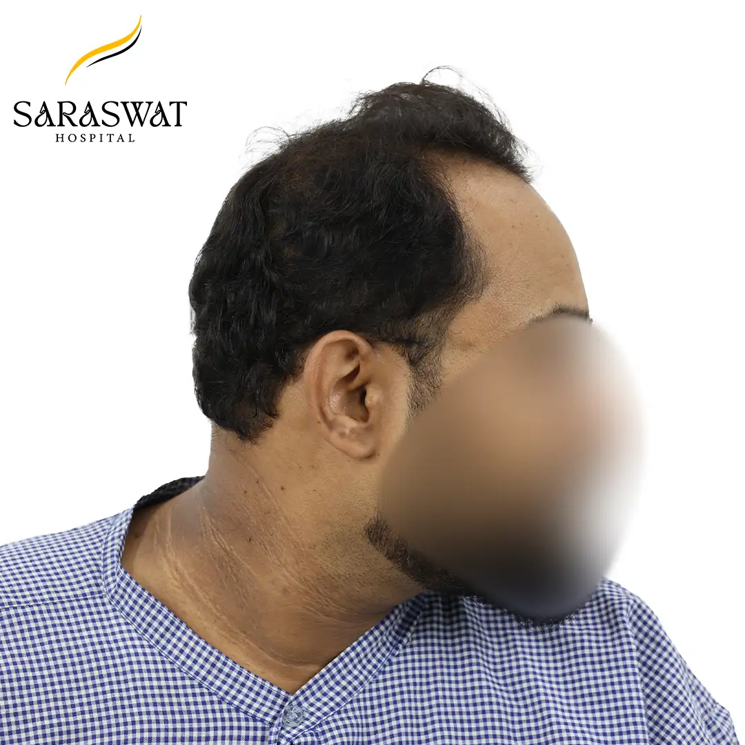 Hair Transplant Before After