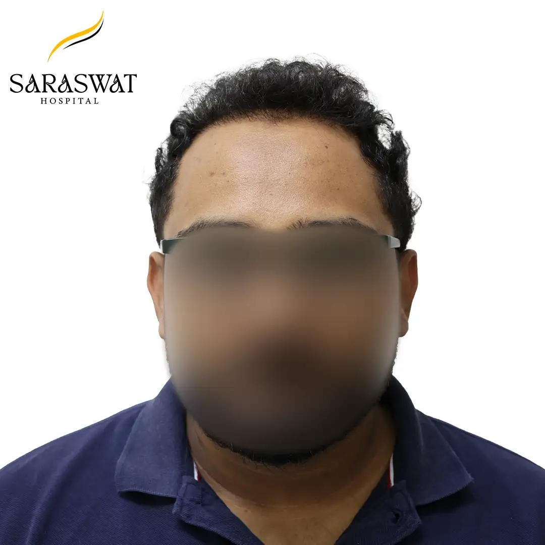 Hair Transplant Before After