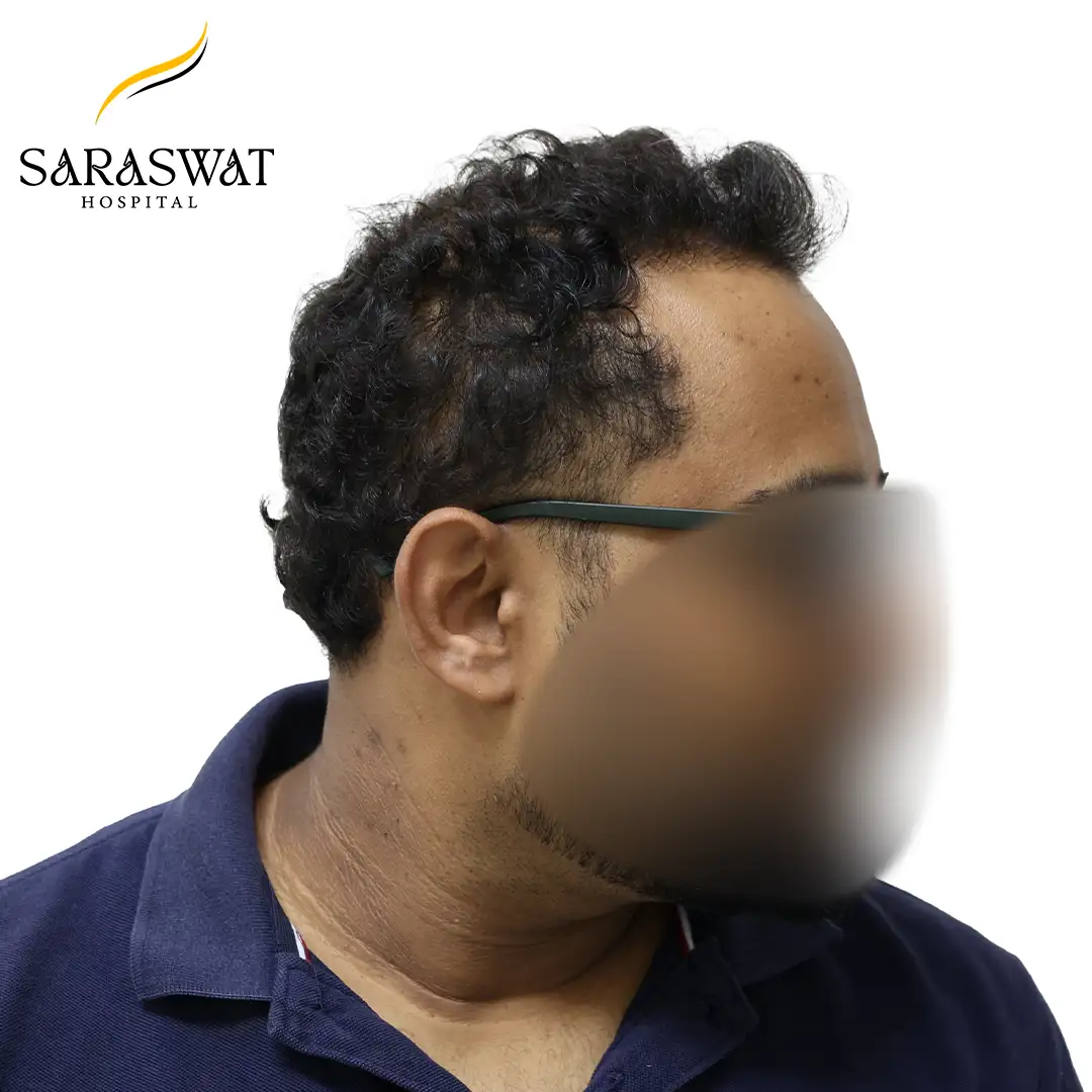 Hair Transplant Before After