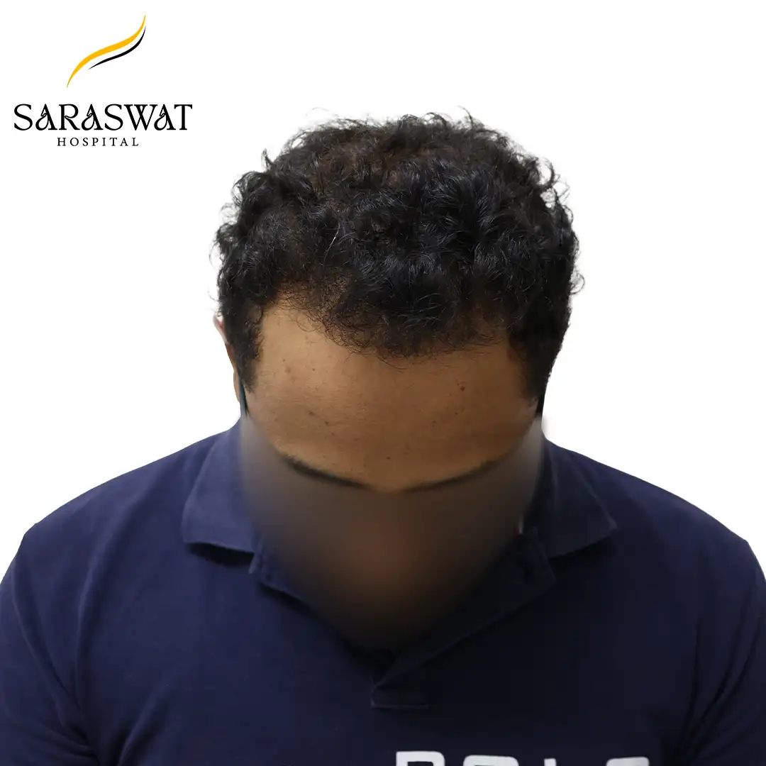 Hair Transplant Before After