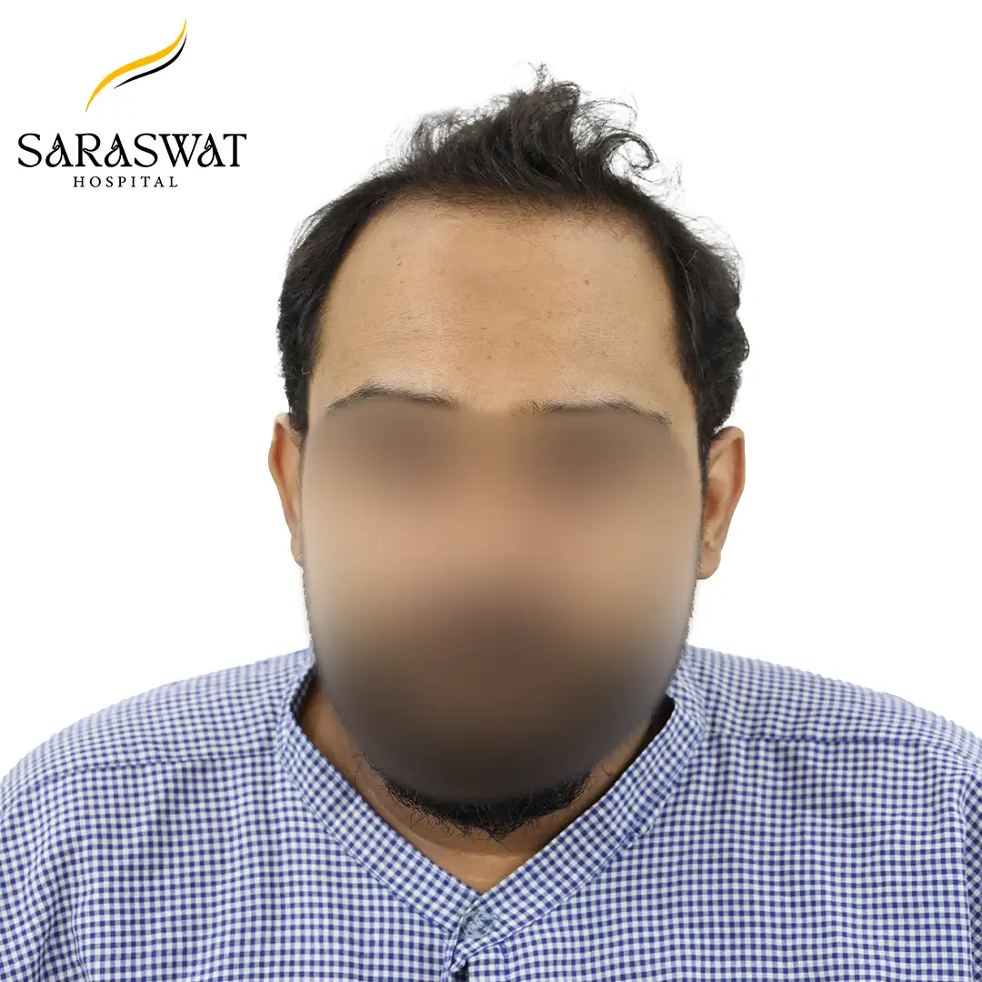 Hair Transplant Before After