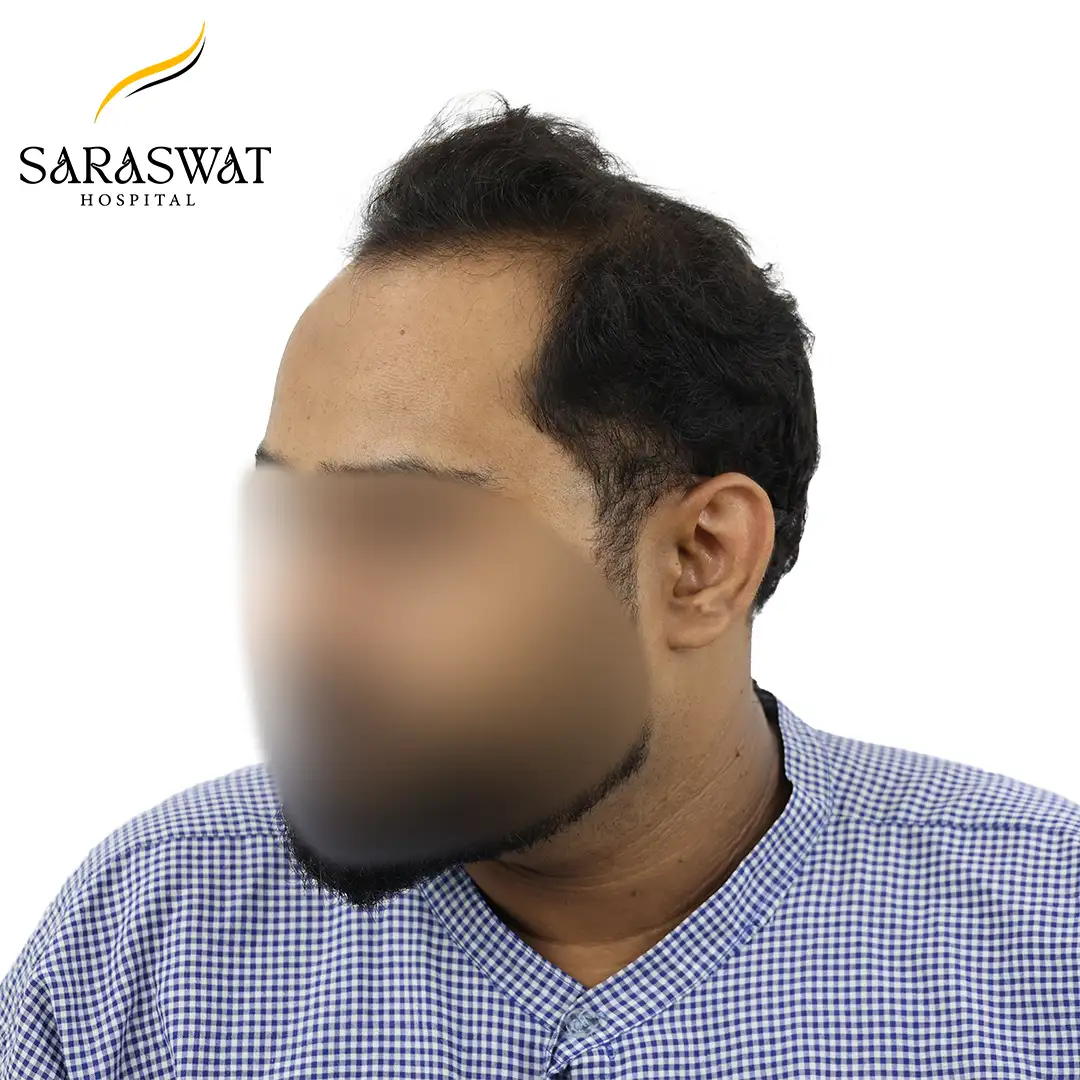 Hair Transplant Before After