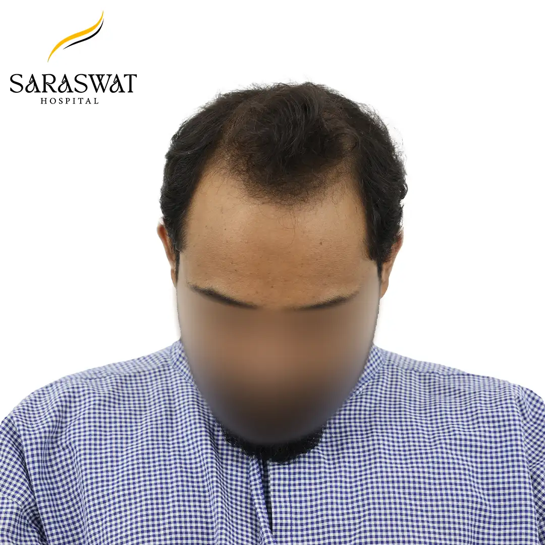 Hair Transplant Before After