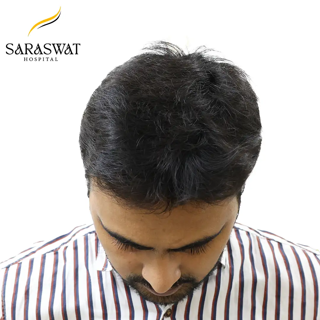 Top FUE Hair Transplant Result After Procedure