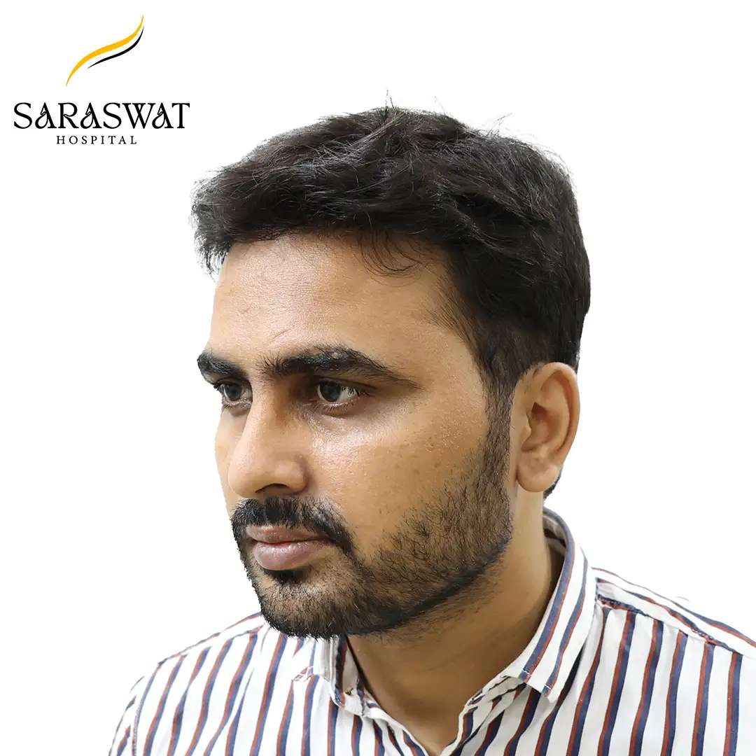 45 Degree Left FUE Hair Transplant Result After Procedure