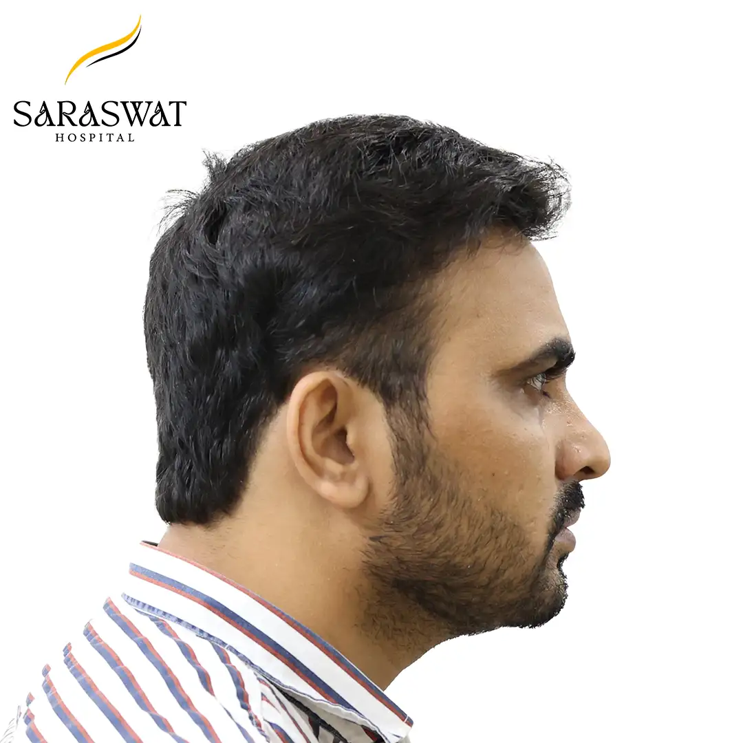 90 Degree Right FUE Hair Transplant Result After Procedure