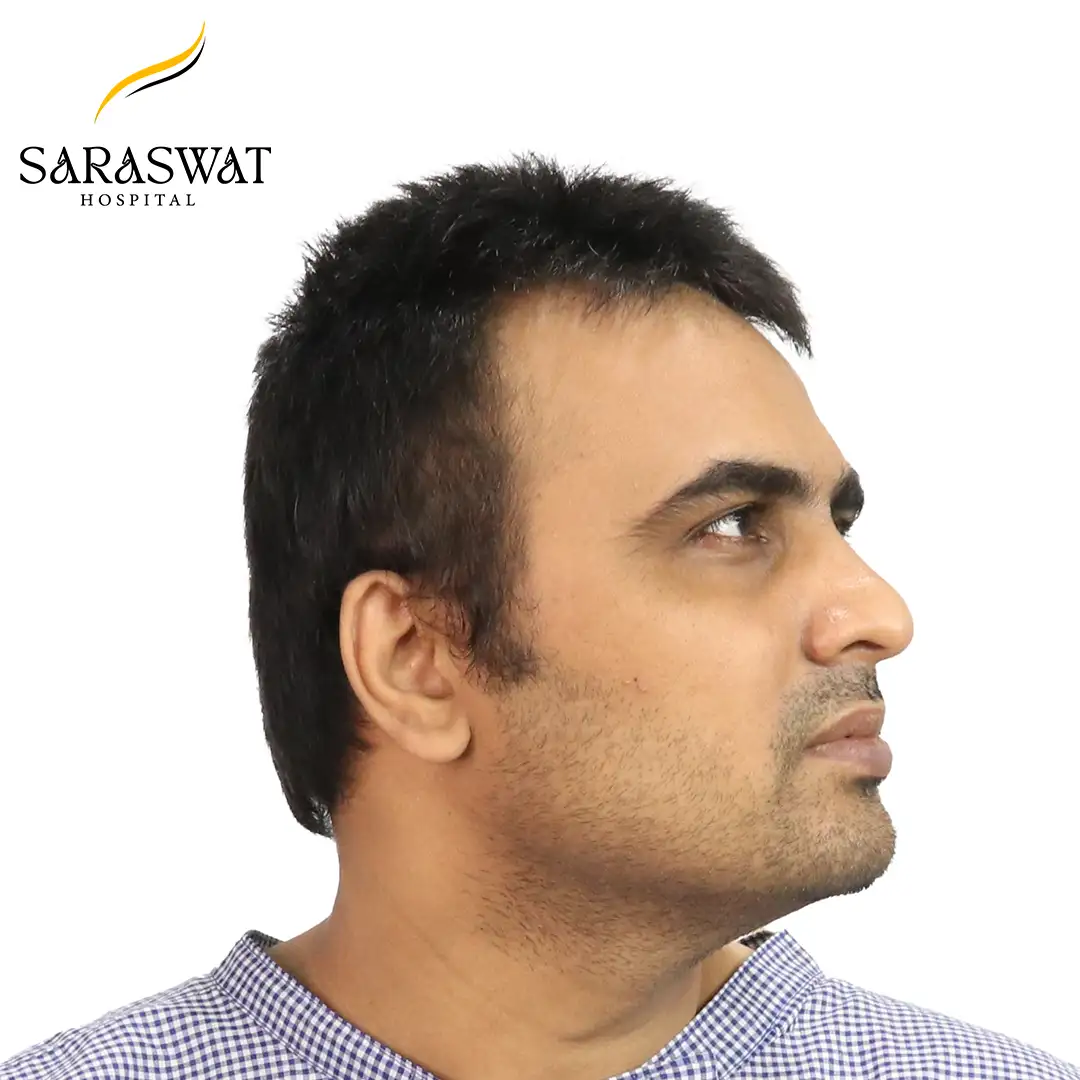 90 Degree Right FUE Hair Transplant Result Before Procedure