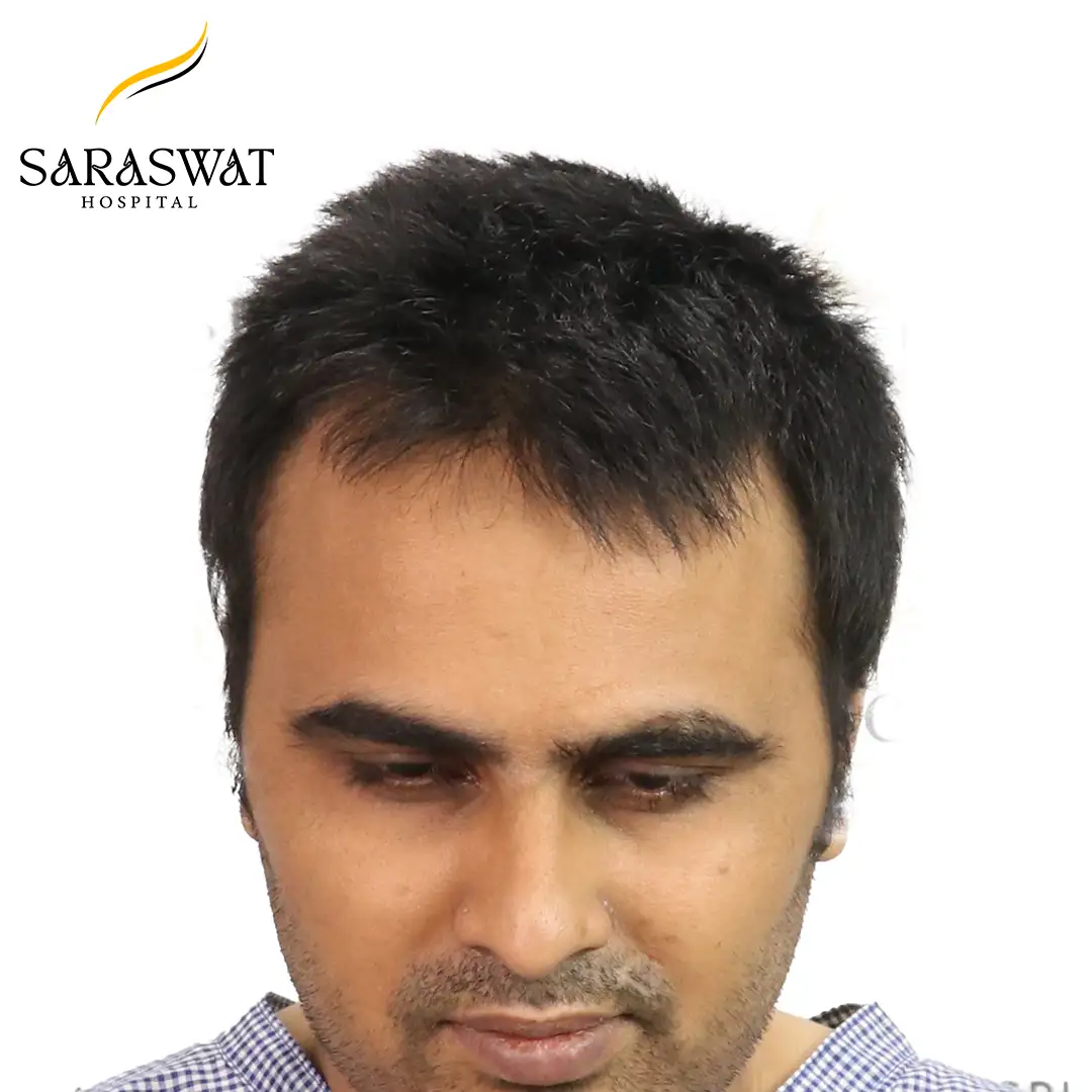 Top FUE Hair Transplant Result Before Procedure