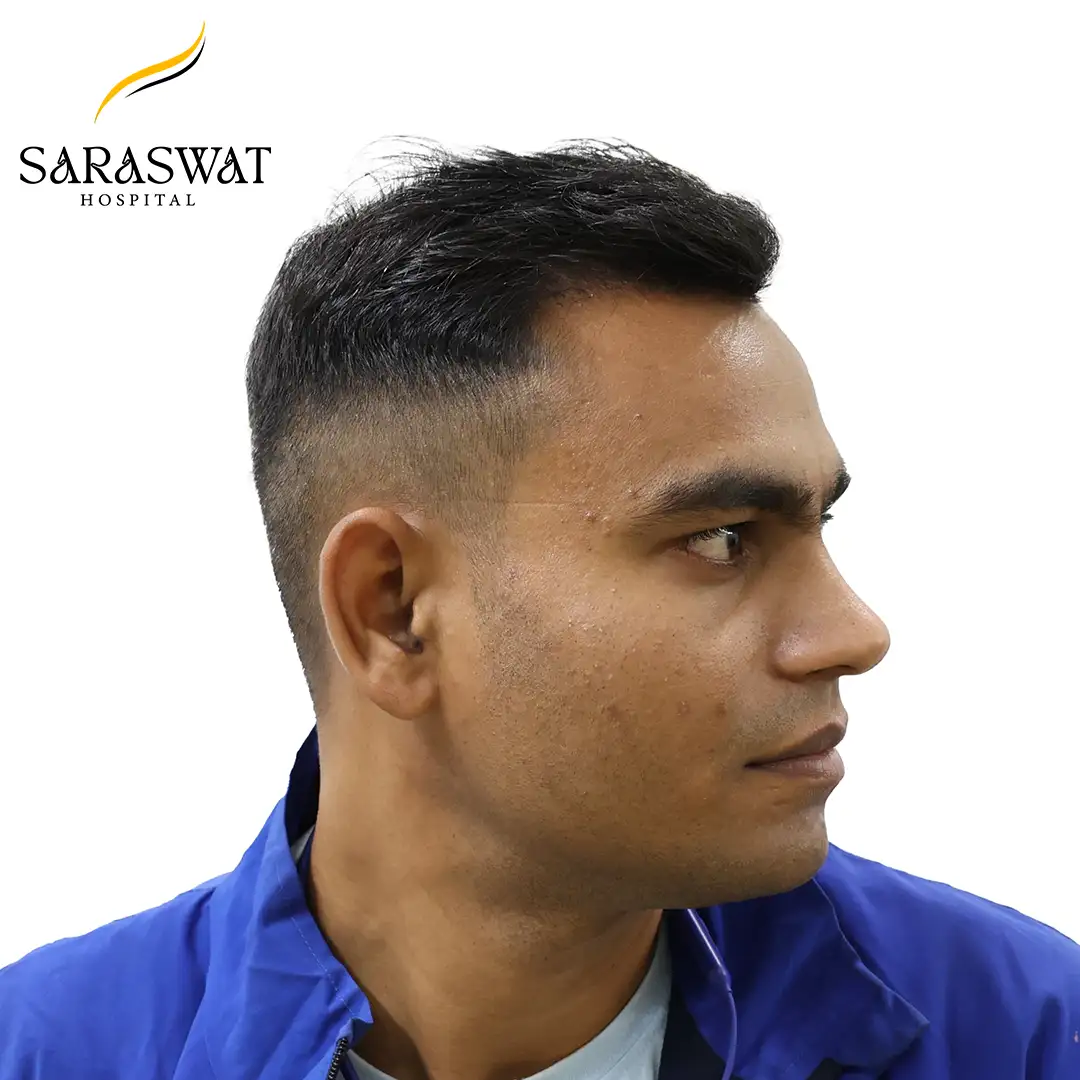 90 Degree Right FUE Hair Transplant Result After Procedure