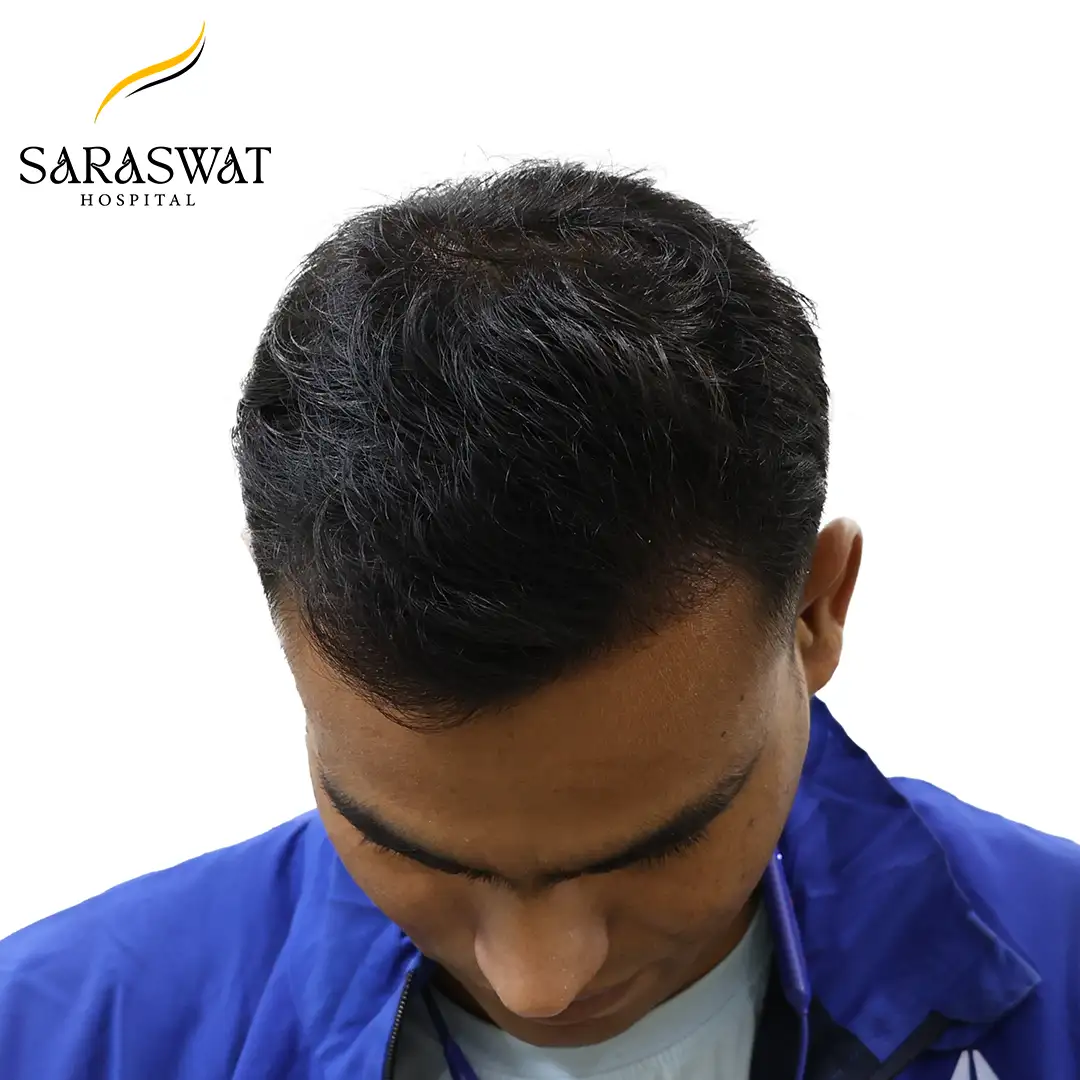 Top FUE Hair Transplant Result After Procedure