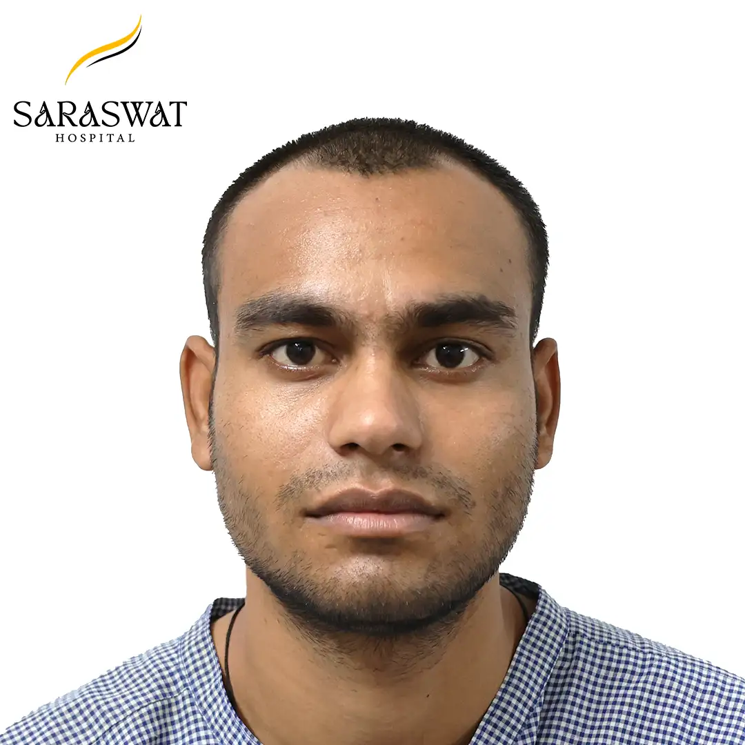 Front FUE Hair Transplant Result Before Procedure