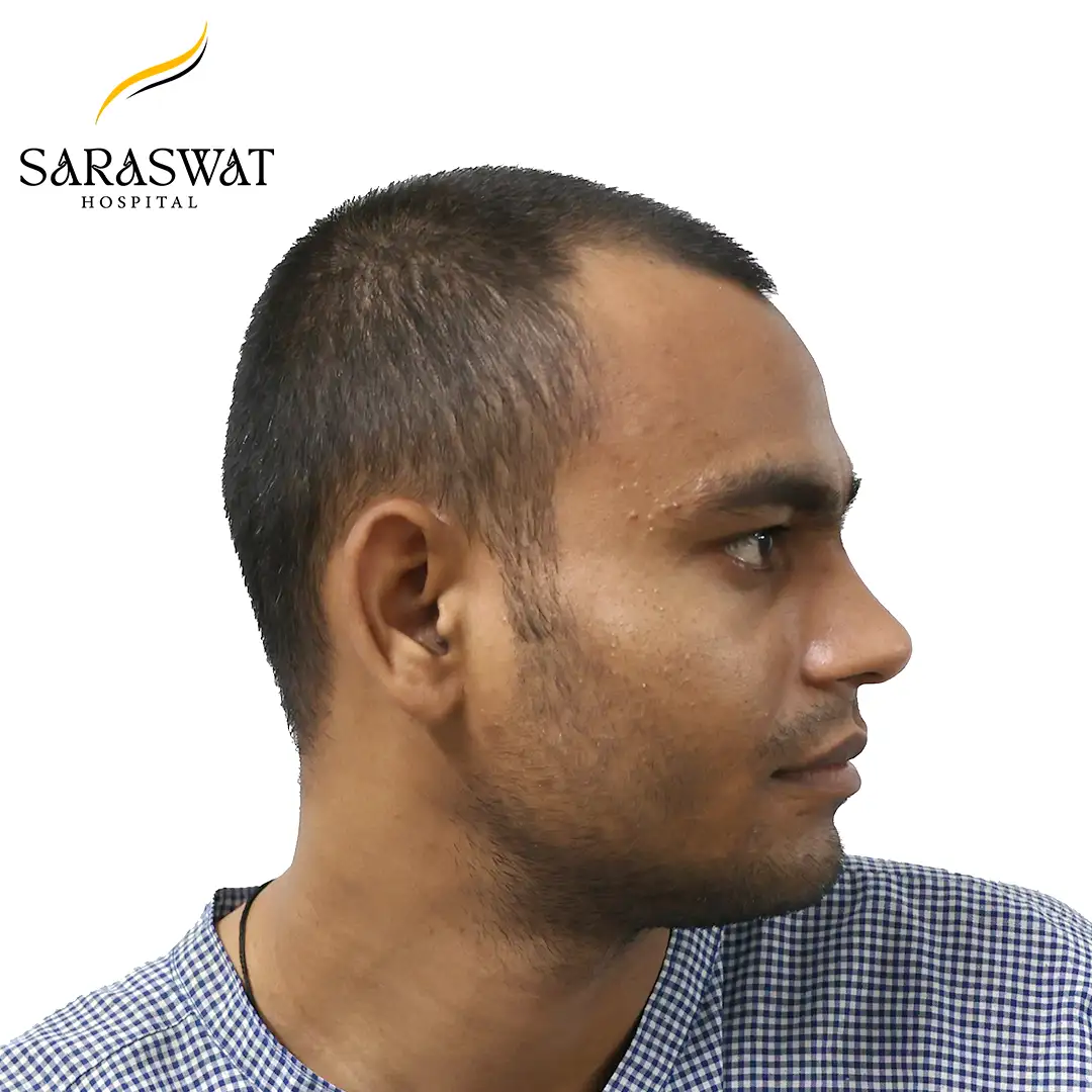 90 Degree Right FUE Hair Transplant Result Before Procedure