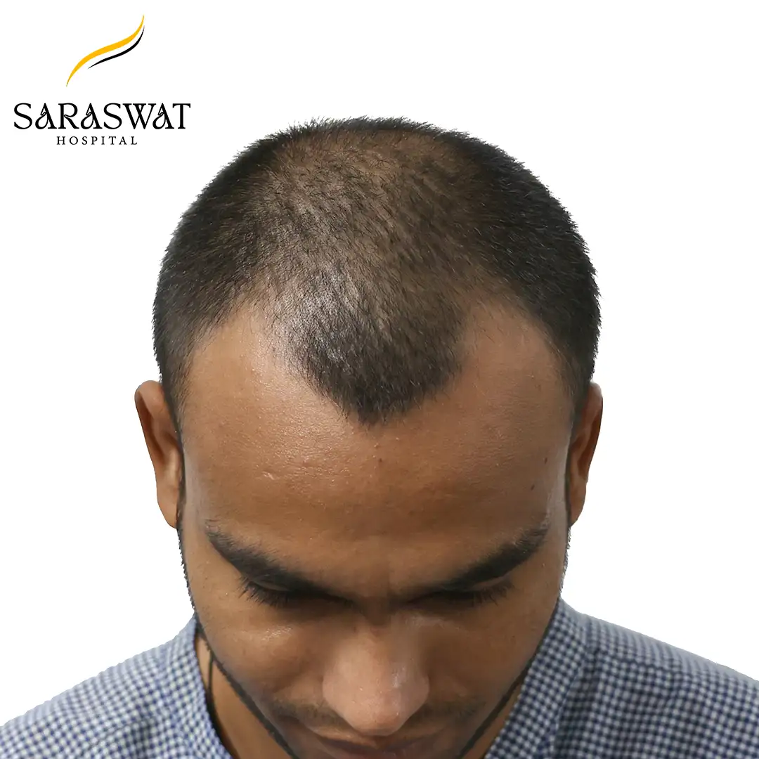 Top FUE Hair Transplant Result Before Procedure