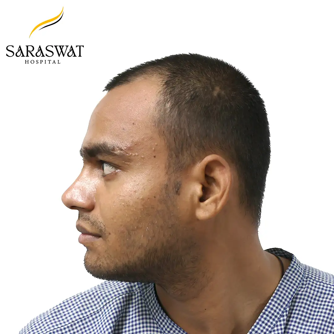 90 Degree Left FUE Hair Transplant Result Before Procedure