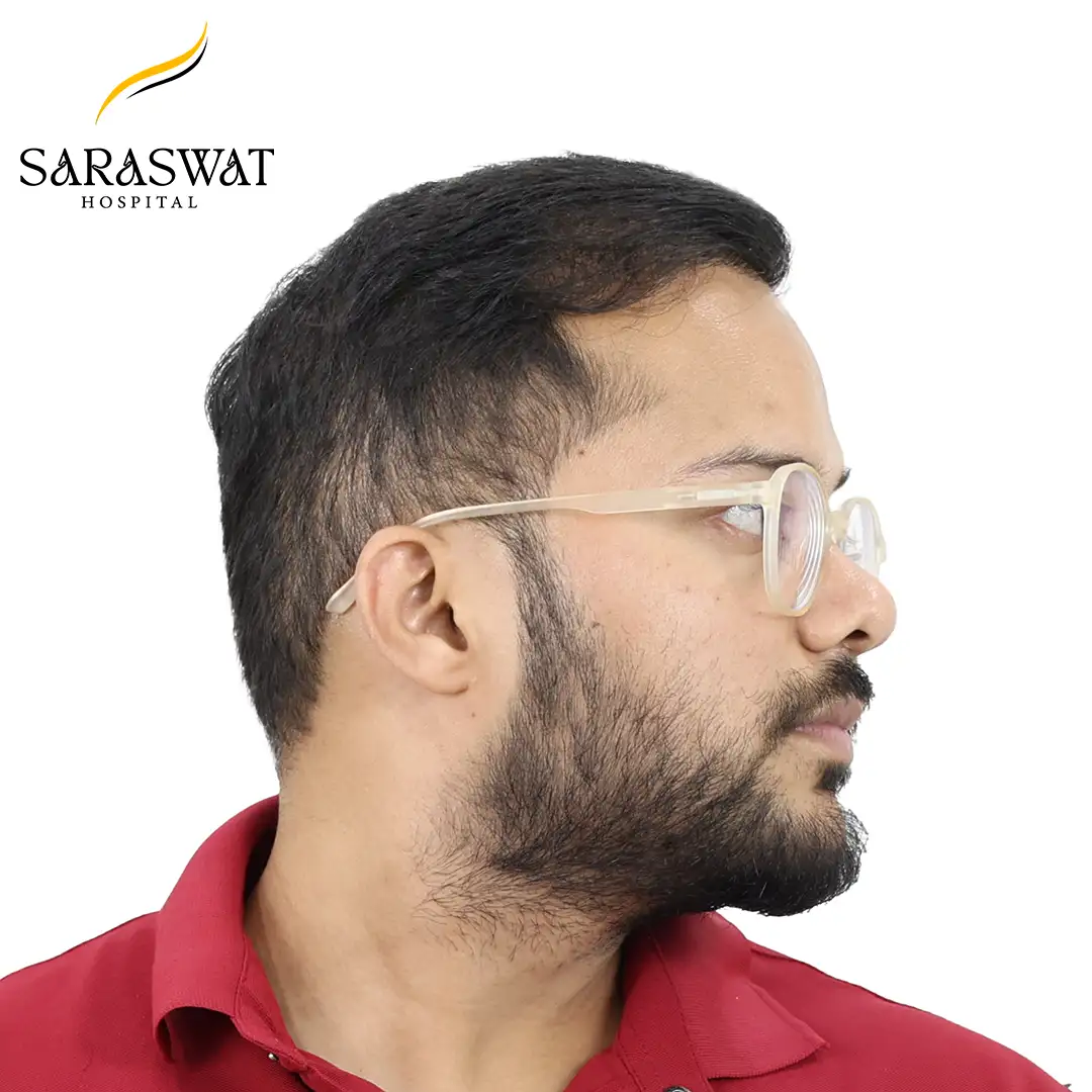 90 Degree Hair Transplant Result