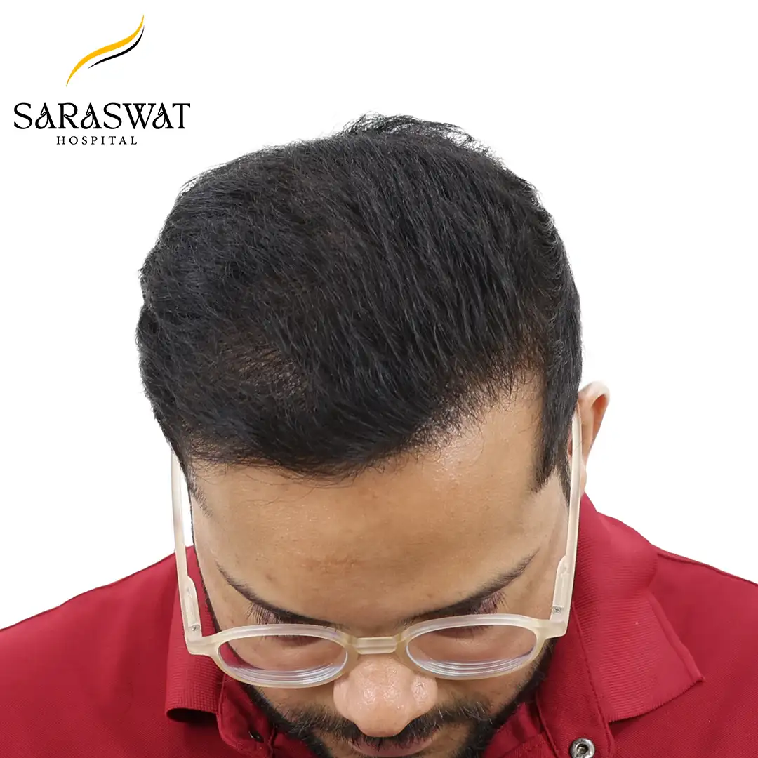 Top Hair Transplant Before and After