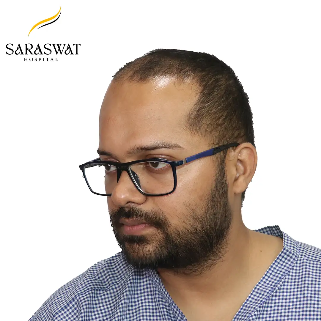 45 Degree Hair Transplant Result