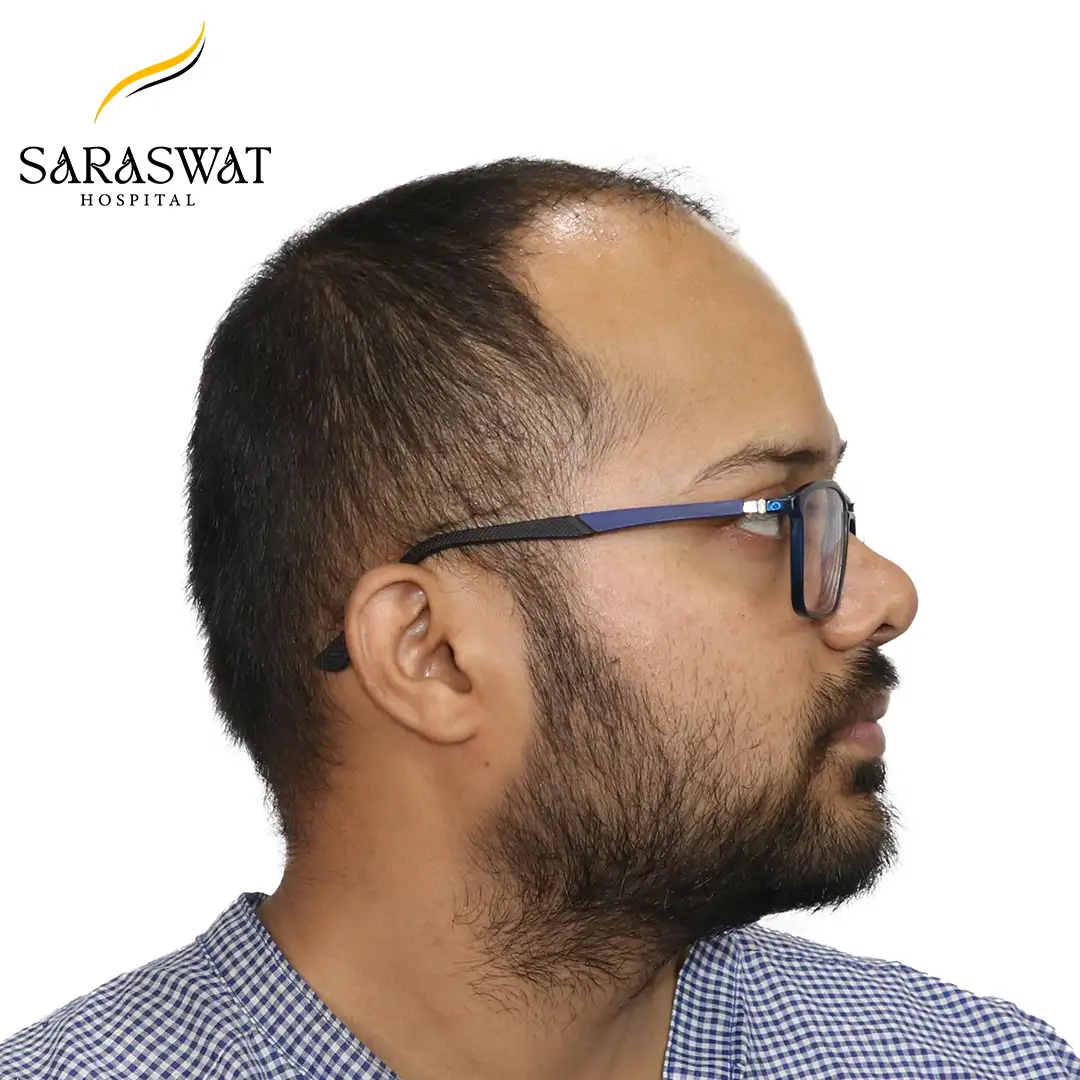 90 Degree Hair Transplant Result