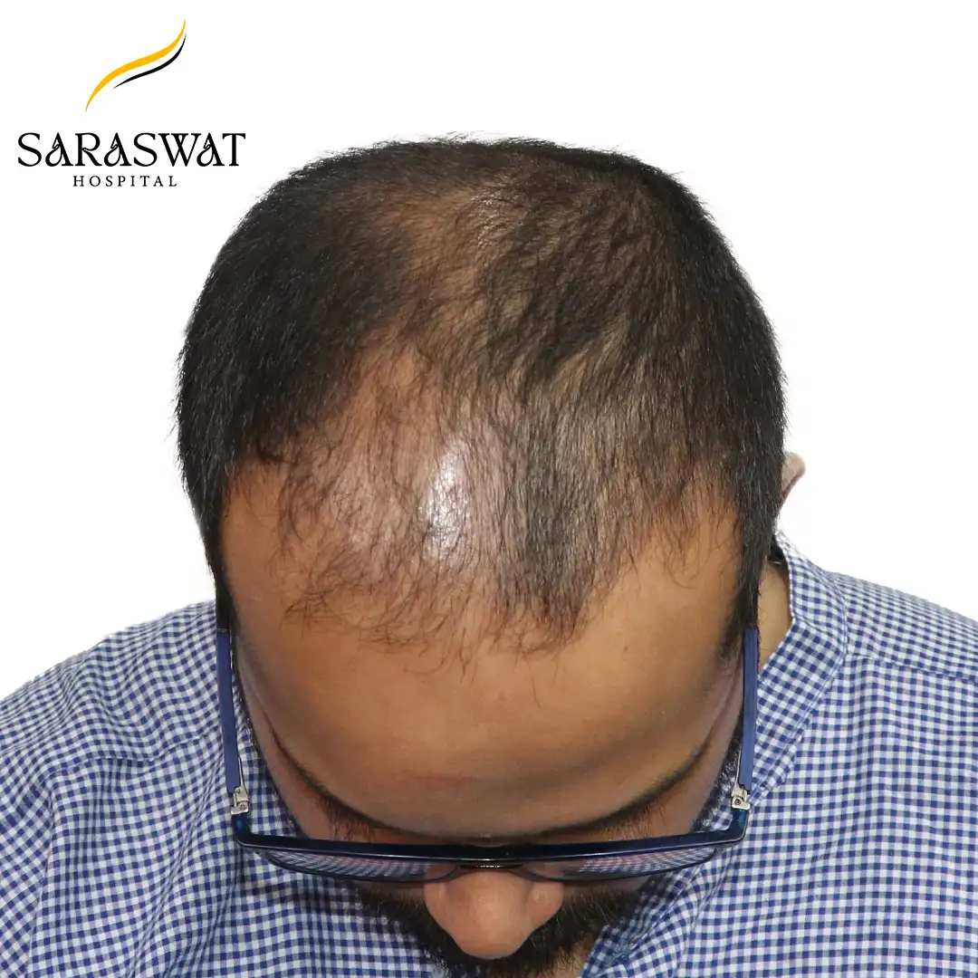 Top Hair Transplant Before and After