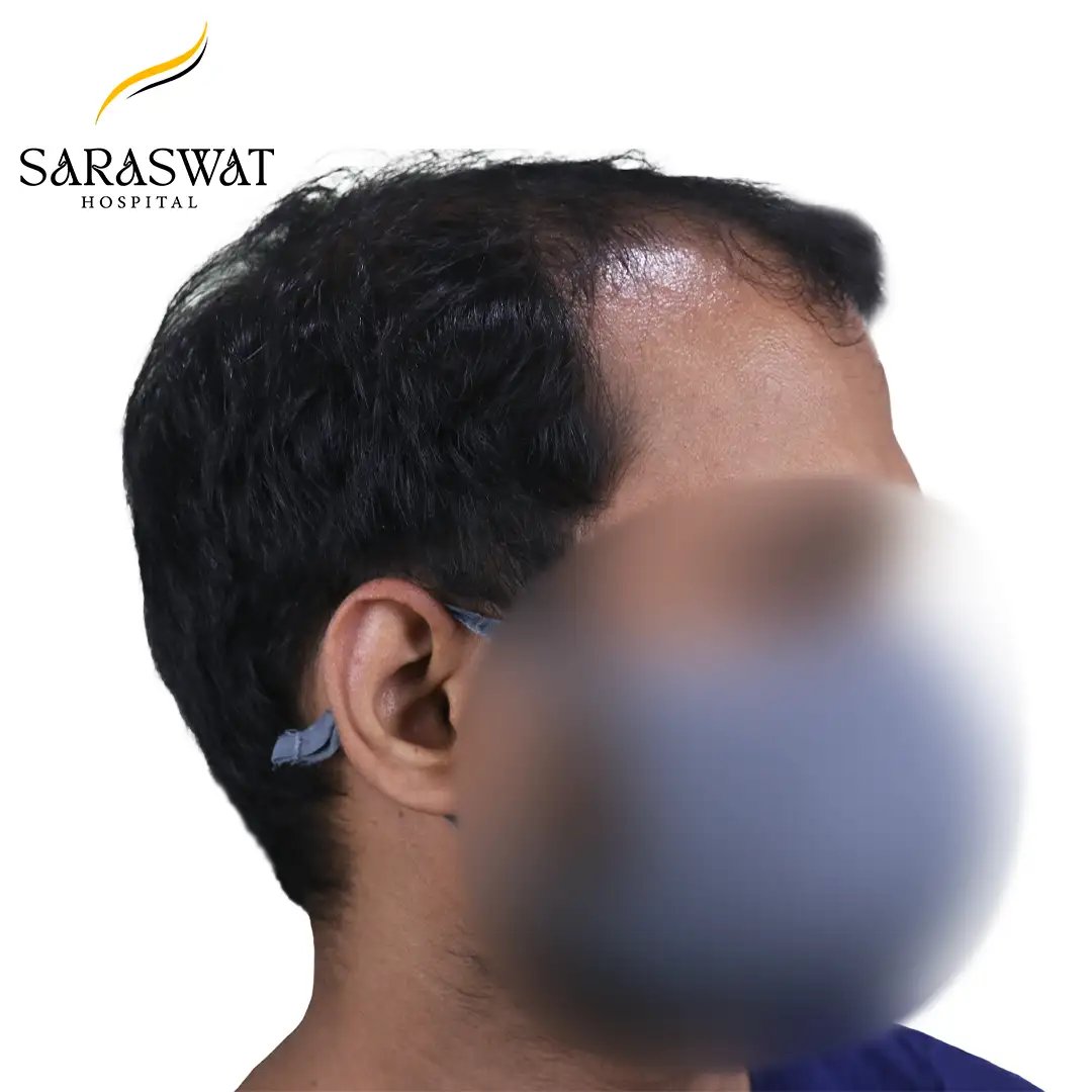 90 Degree Right FUE Hair Transplant Result Before Procedure