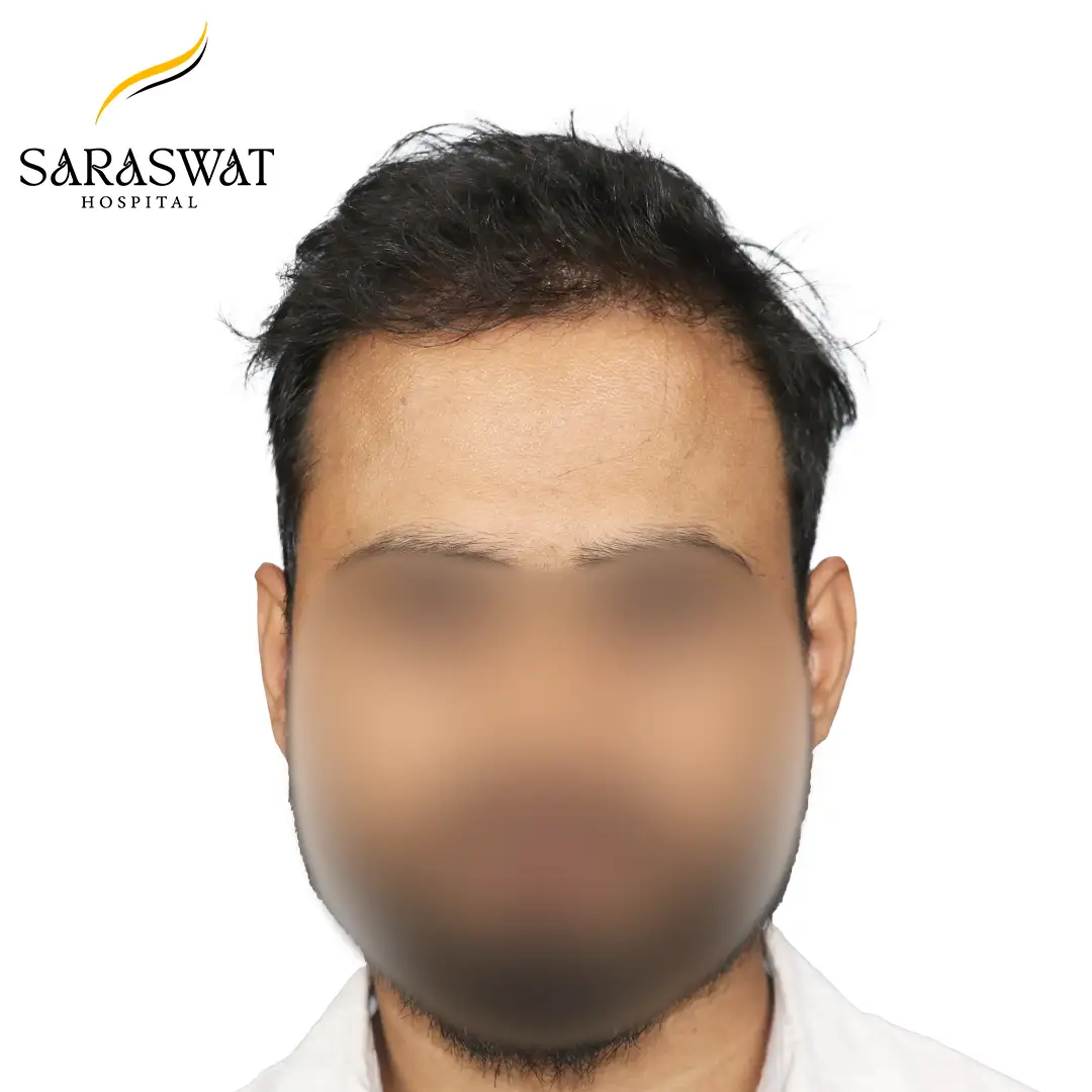 Front FUE Hair Transplant Result After Procedure