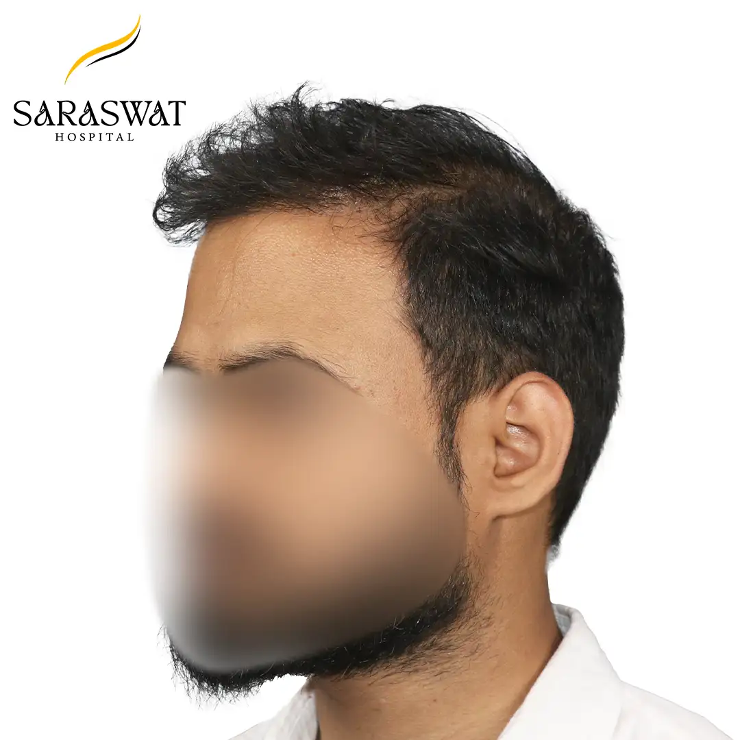 45 Degree Left FUE Hair Transplant Result After Procedure