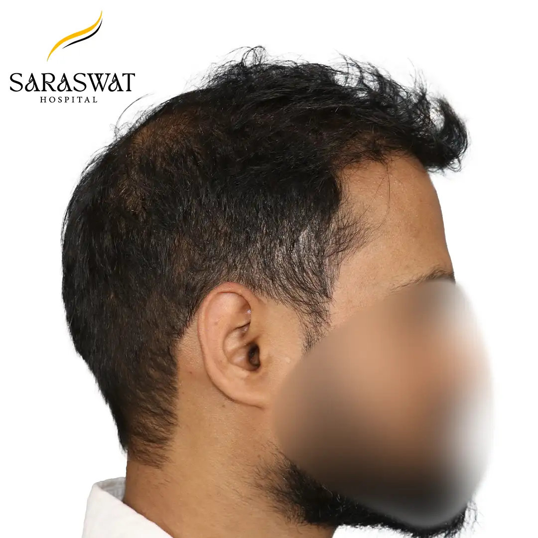 90 Degree Right FUE Hair Transplant Result After Procedure